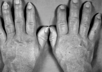 Enlarged hands are characteristic of acromegaly, the condition Lanreotide treats.